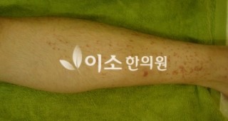 beforeㄱㅈㄱ_10대_청소년_자반_전,_좌측_다리