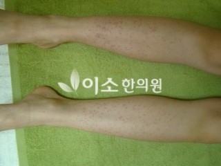 ㄱㅁㅅ_초등학생_자반_치료_전_(1) (1)