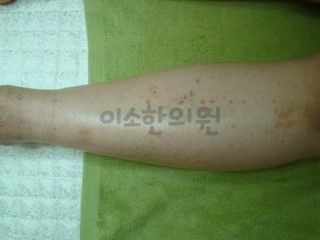 ㄱㅁㅅ_치료_전_(3)