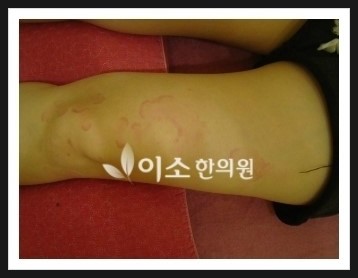ㅇㅇㅎ_두드러기_전_좌측_허벅지 (1)