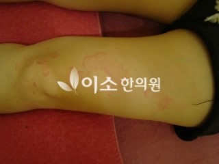 ㅇㅇㅎ_두드러기_전_좌측_허벅지