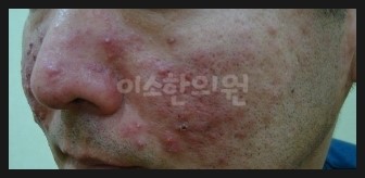 ㅈㅇㅊ_지루성_피부염_좌측_전