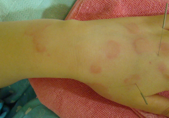 두드러기_손 (1)