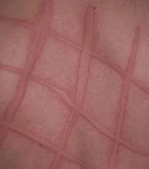 두드러기_자료_사진