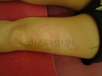두드러기_치료전_(1)