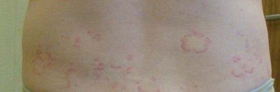 등,_두드러기_전 (1)