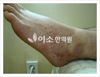 발쪽_자반증_(2)