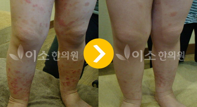 소아자반증치료전후사진
