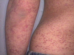 자반증_자료_사진_-_복사본 (1)