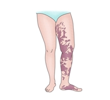 자반증_자료사진_-_복사본