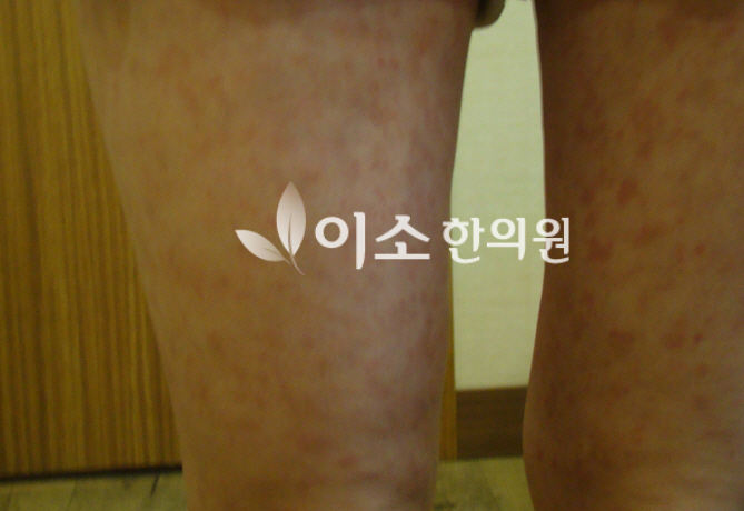 장미색_비강진_증상_우측_다리