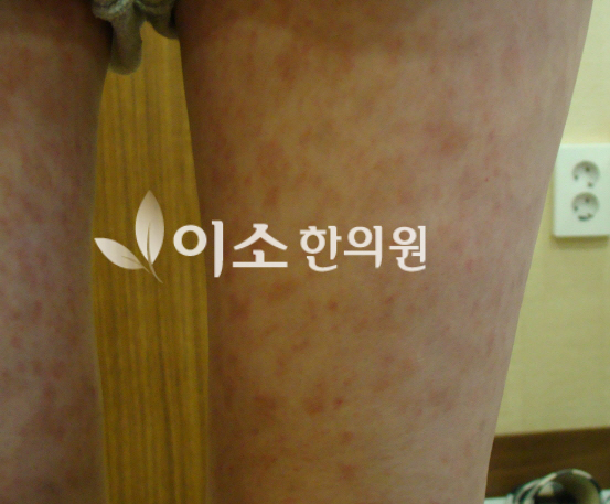 장미색_비강진_증상_좌측_다리