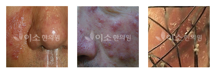 지루성피부염사례