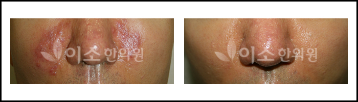 지루성피부염치료사례_01