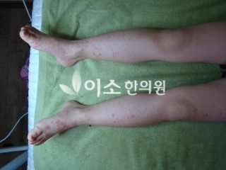 최예은_치료_전