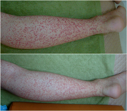 색소성 자반증 변화